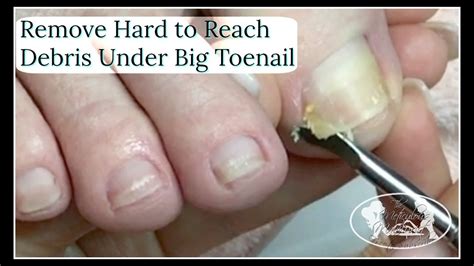 In fact, one type of bacteria, brevibacterium, lives in between the toes, thrives in a damp, salty environment, and produces the <b>cheese</b>-<b>like</b> <b>smell</b> of feet. . Why do my toenails smell like cheese reddit